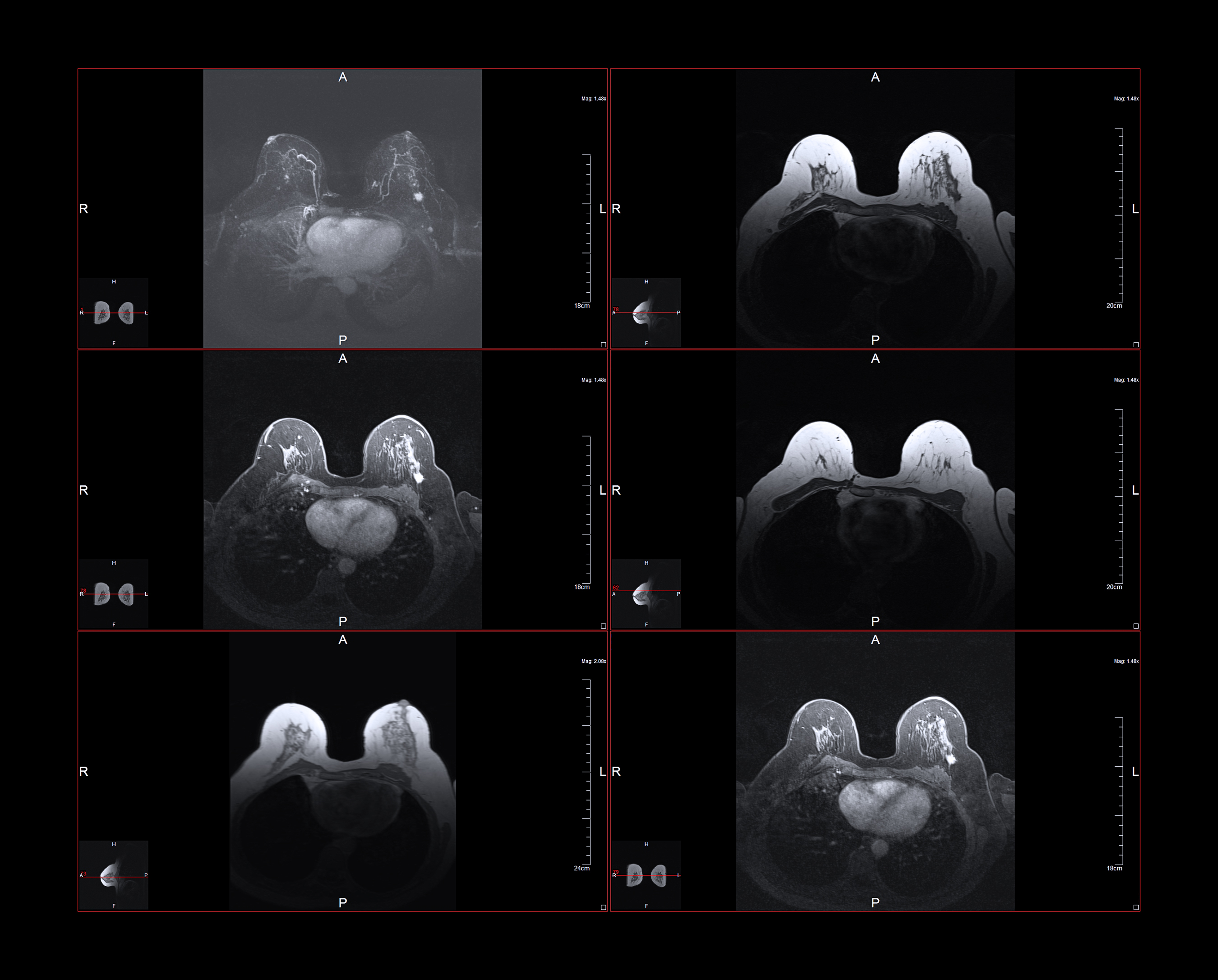 expert-opinion-imaging-and-lobular-breast-cancer-the-lobular-breast